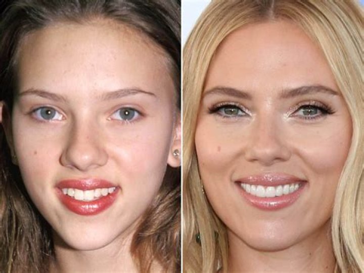 Celebrities That Have Had Composite Bonding & Veneers